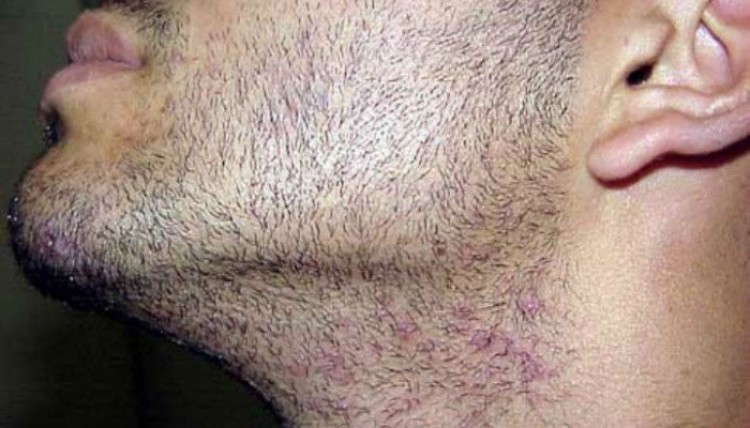 Comment traiter la folliculite dans la barbe