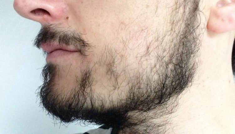 ÉCHEC DE BARBE CE QUI PEUT ÊTRE