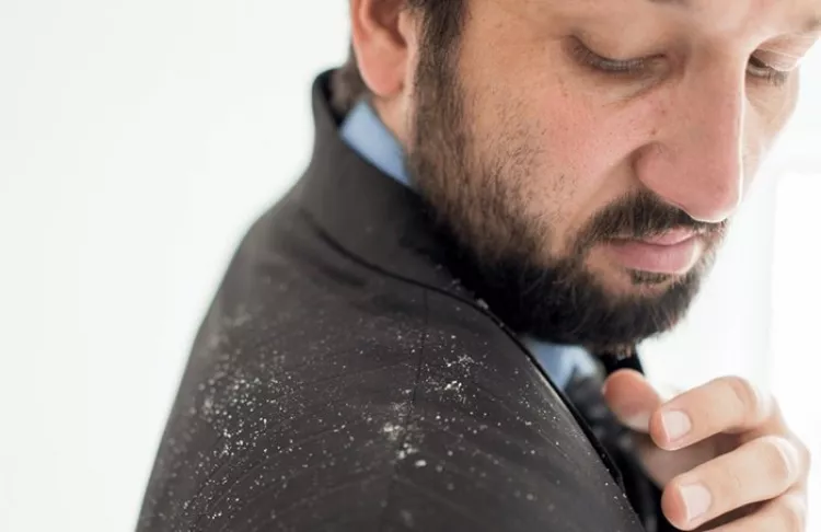 Barbe incarnée ou pellicules dans la barbe - Reproduction