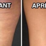 Comment casser la cellulite des cuisses ?